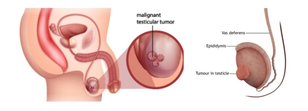 Medical diagram of a human male reproductive system highlighting a malignant testicular tumor in the testis.